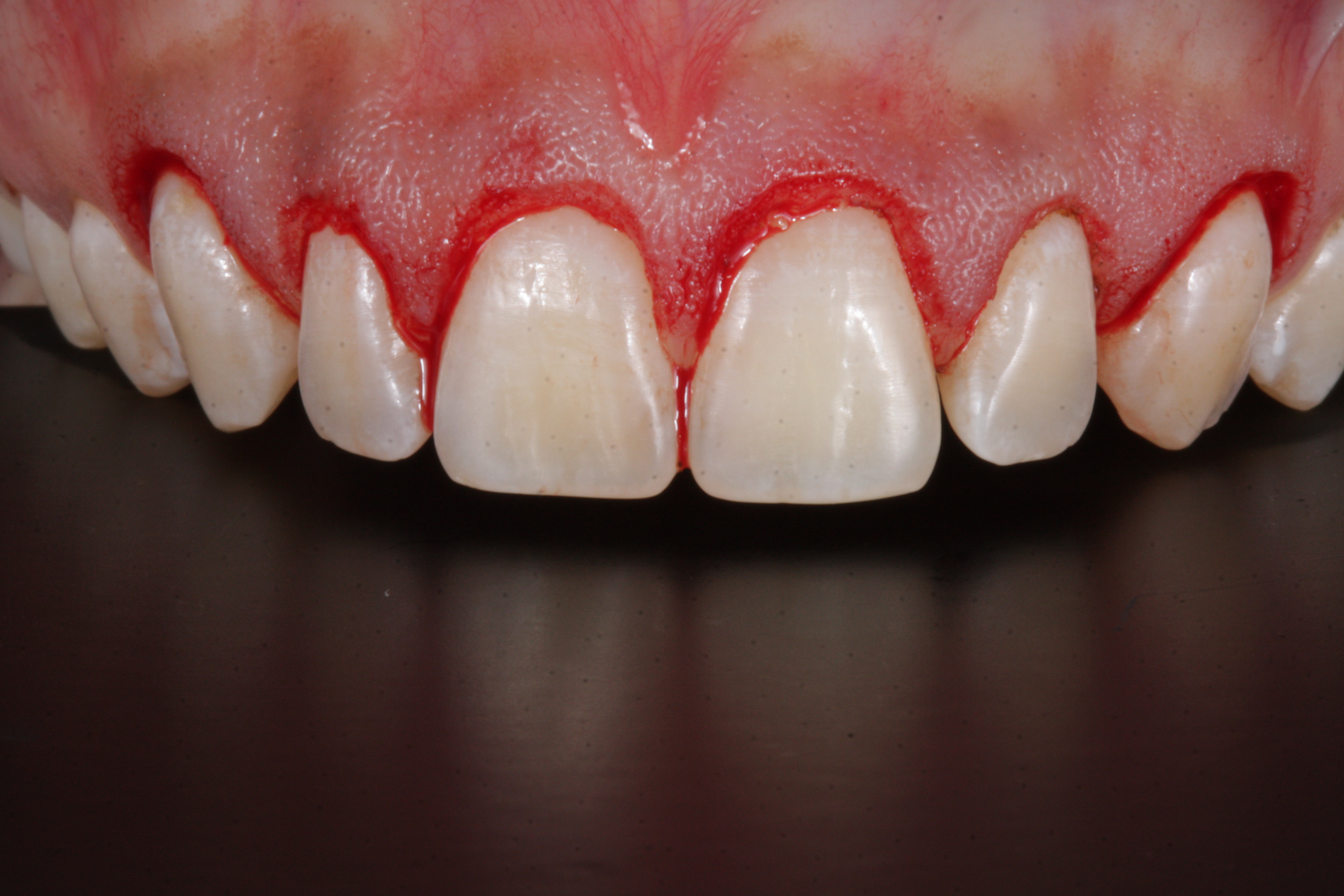 Sorriso Gengival - Foto 5
