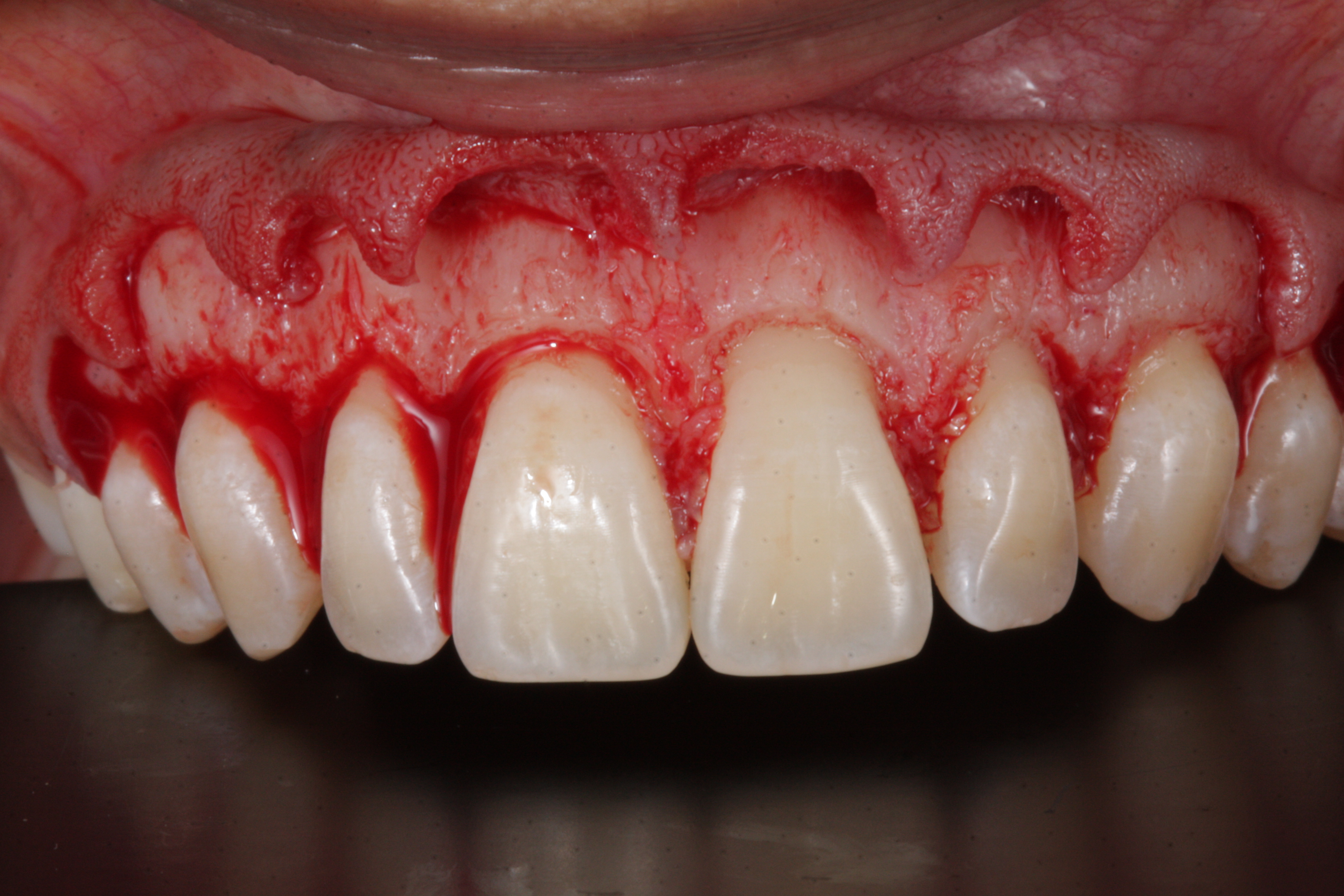 Sorriso Gengival - Foto 7