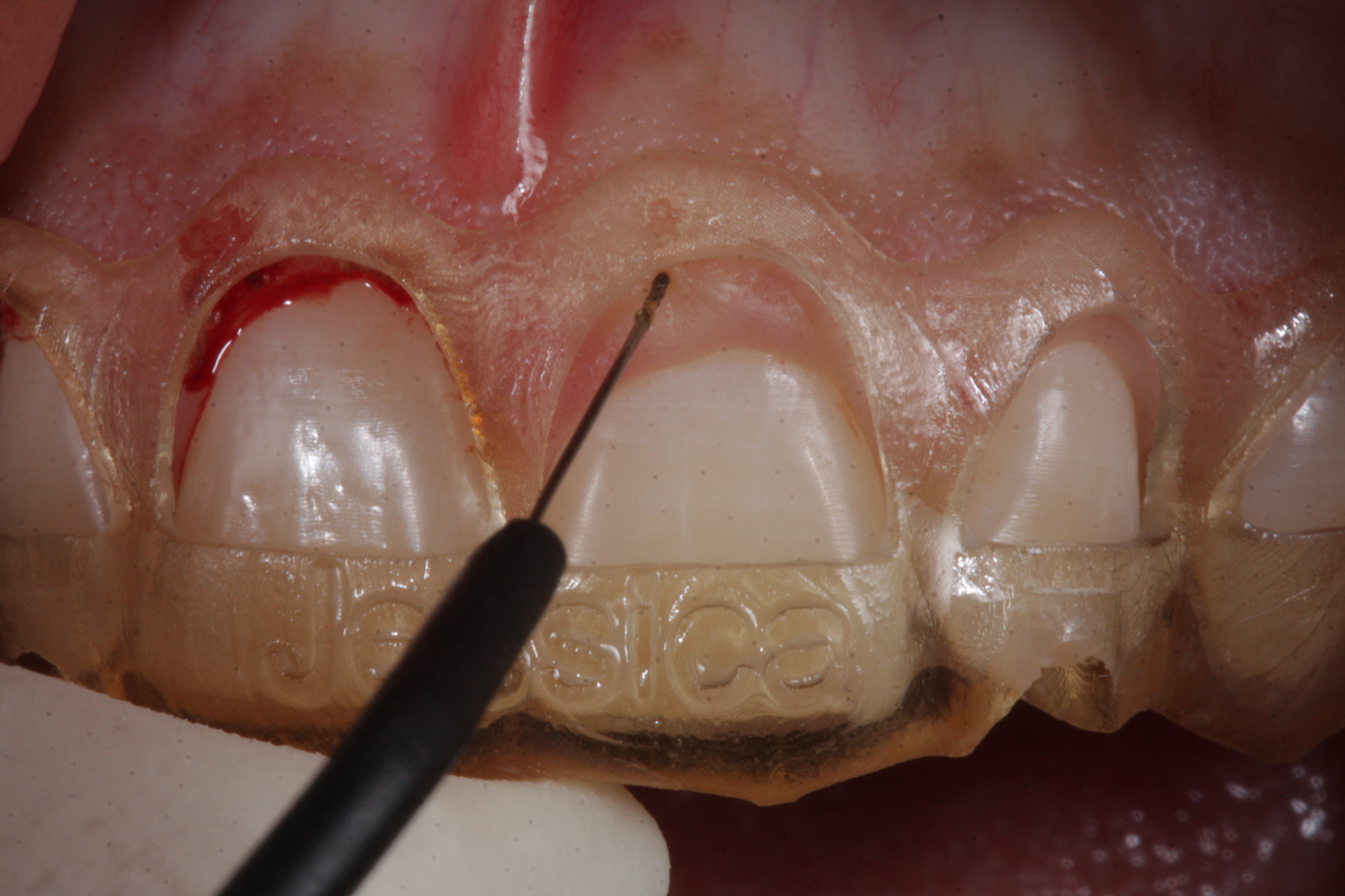 Sorriso Gengival - Foto 4