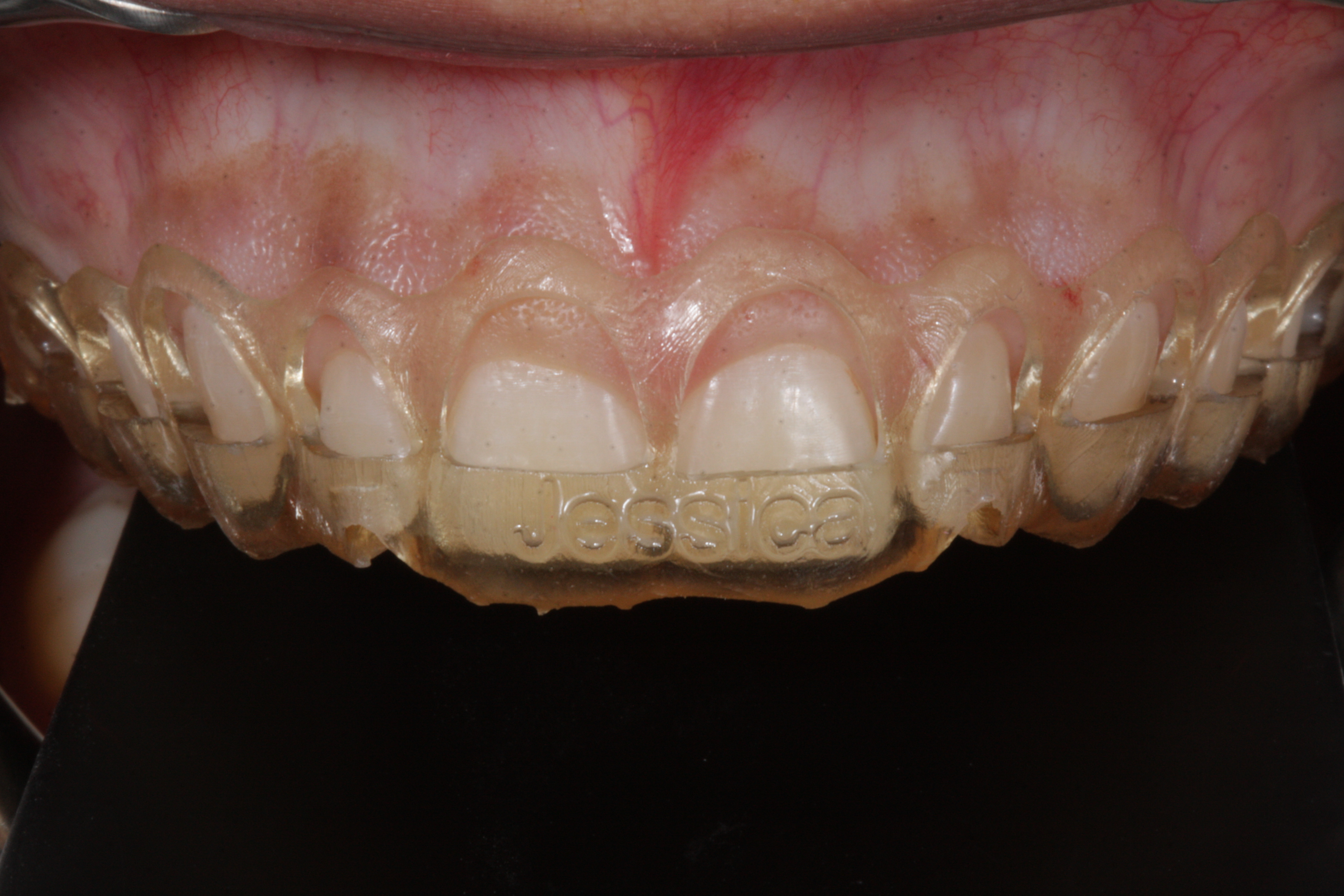 Sorriso Gengival - Foto 3