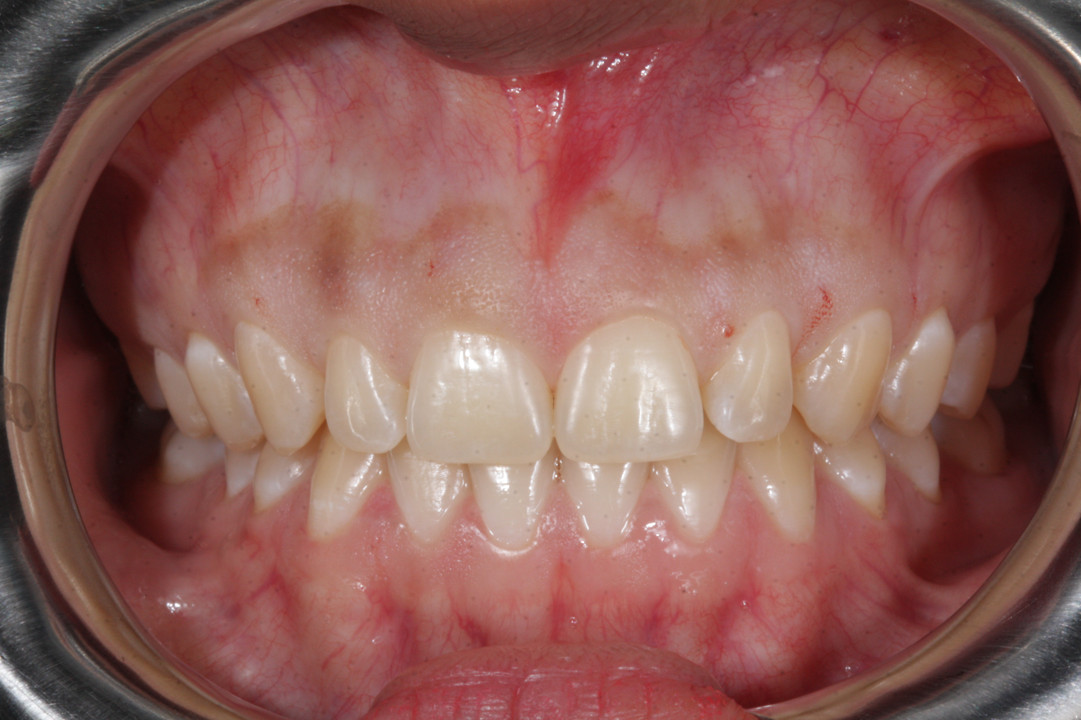 Sorriso Gengival - Foto 2