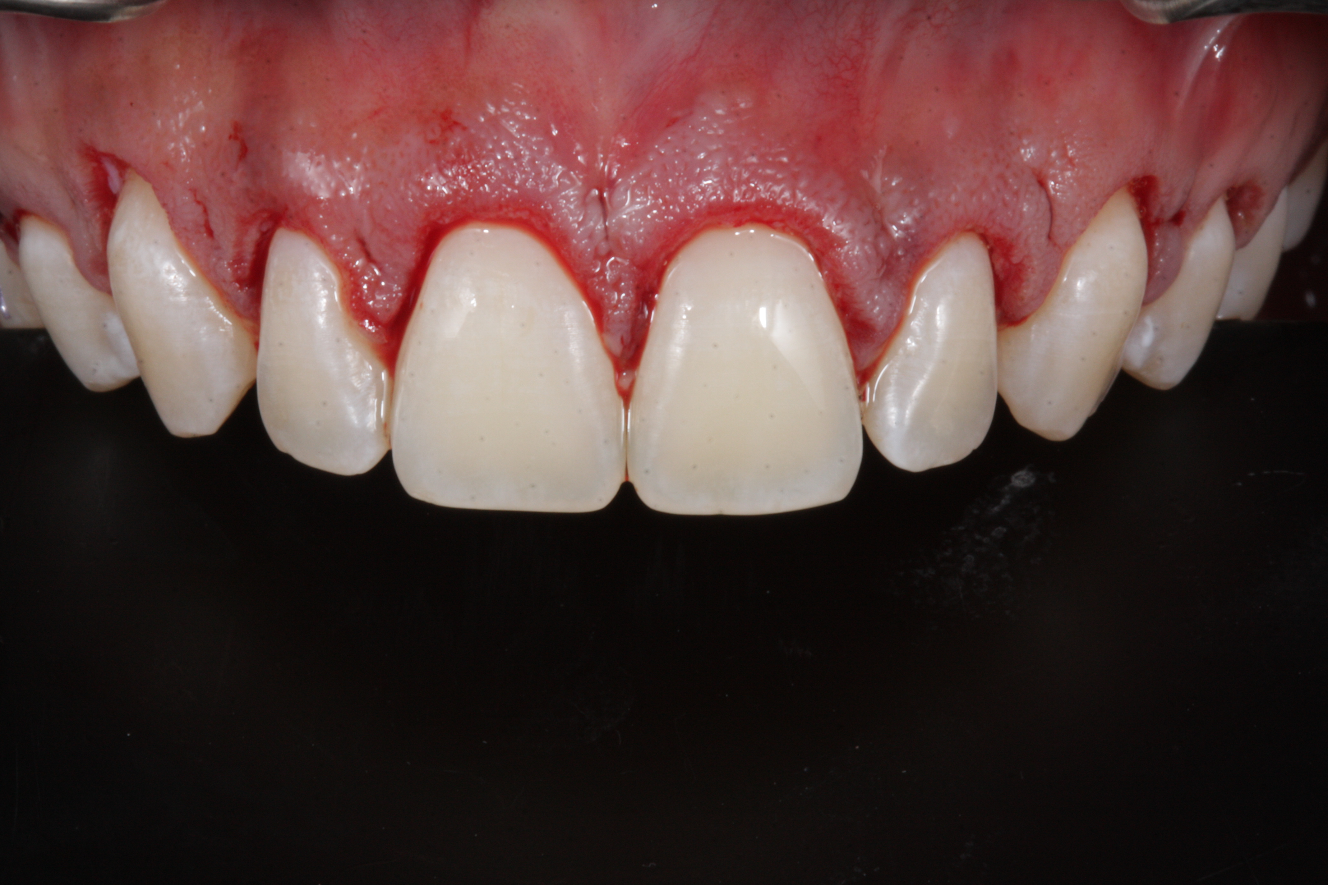 Sorriso Gengival - Foto 8