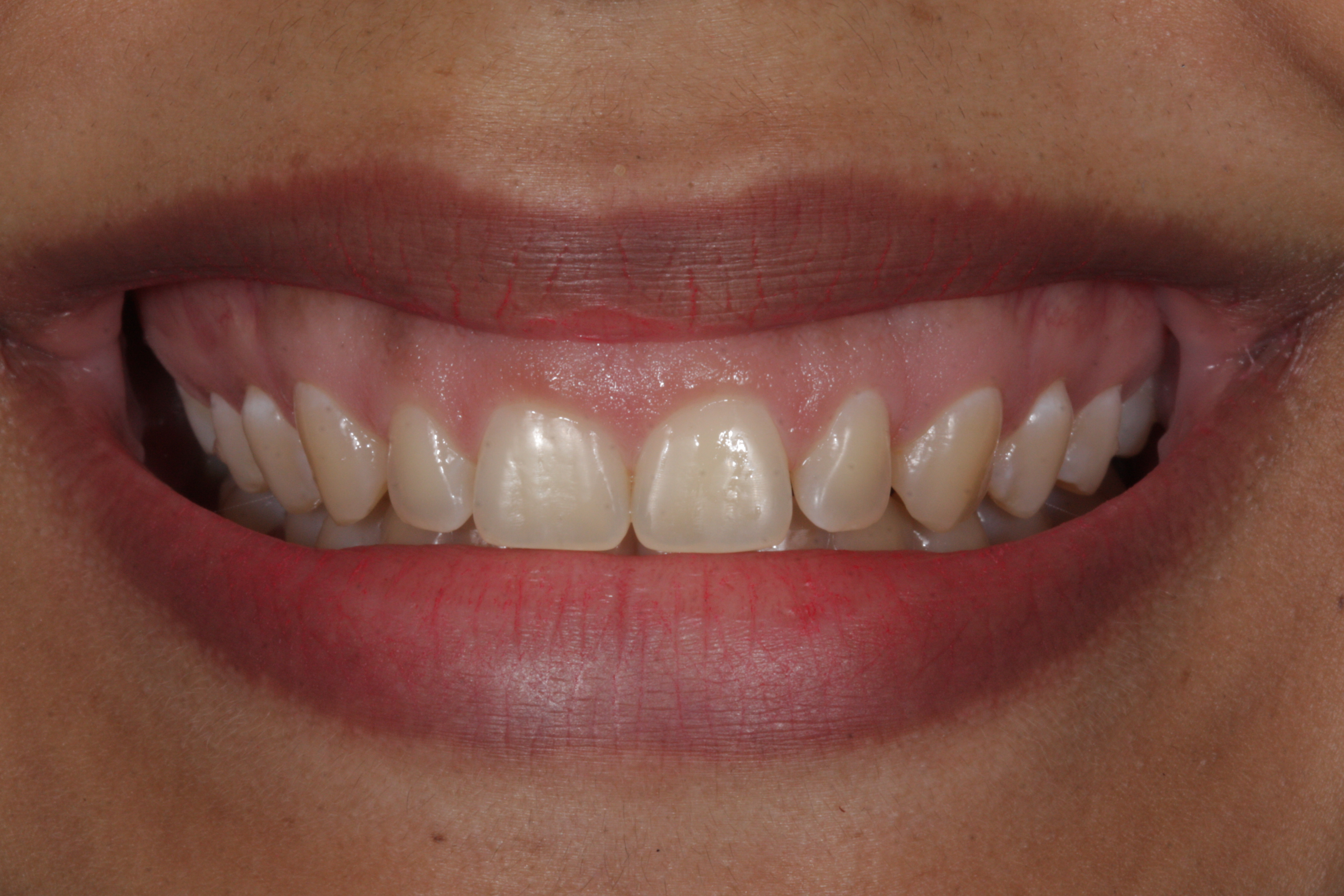 Sorriso Gengival - Foto 1