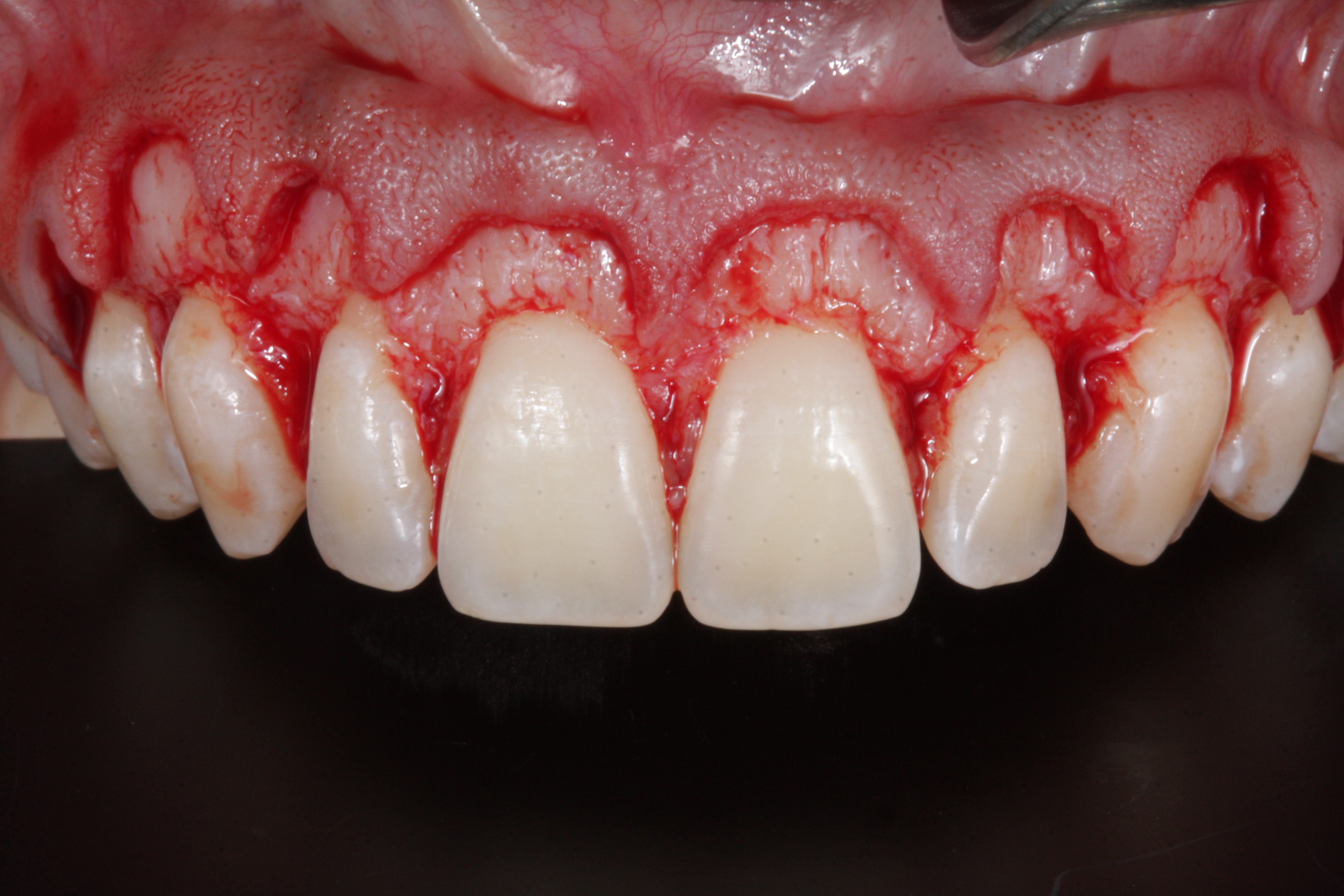 Sorriso Gengival - Foto 6