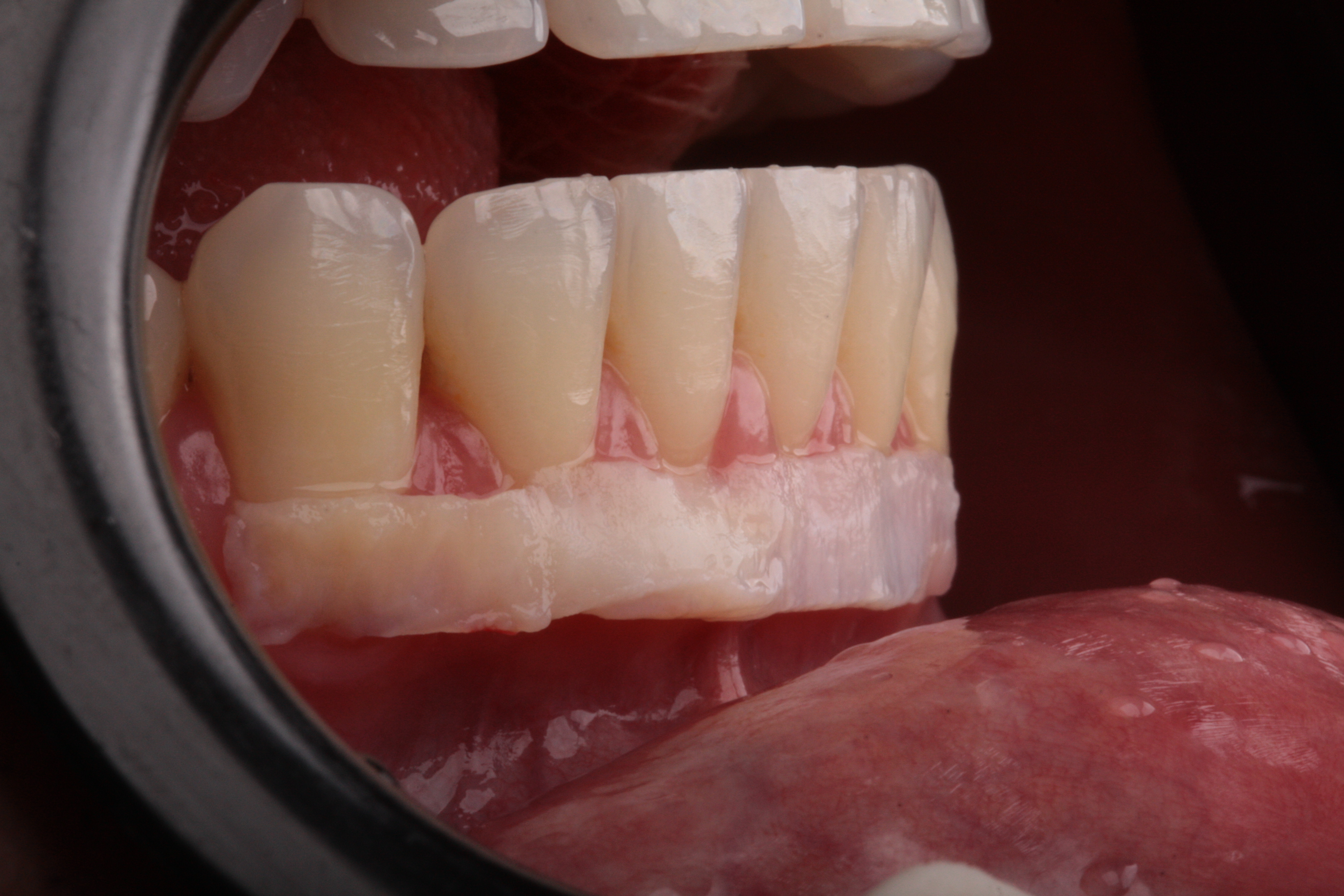 Multiplas Recessões Gengivais - Foto 3