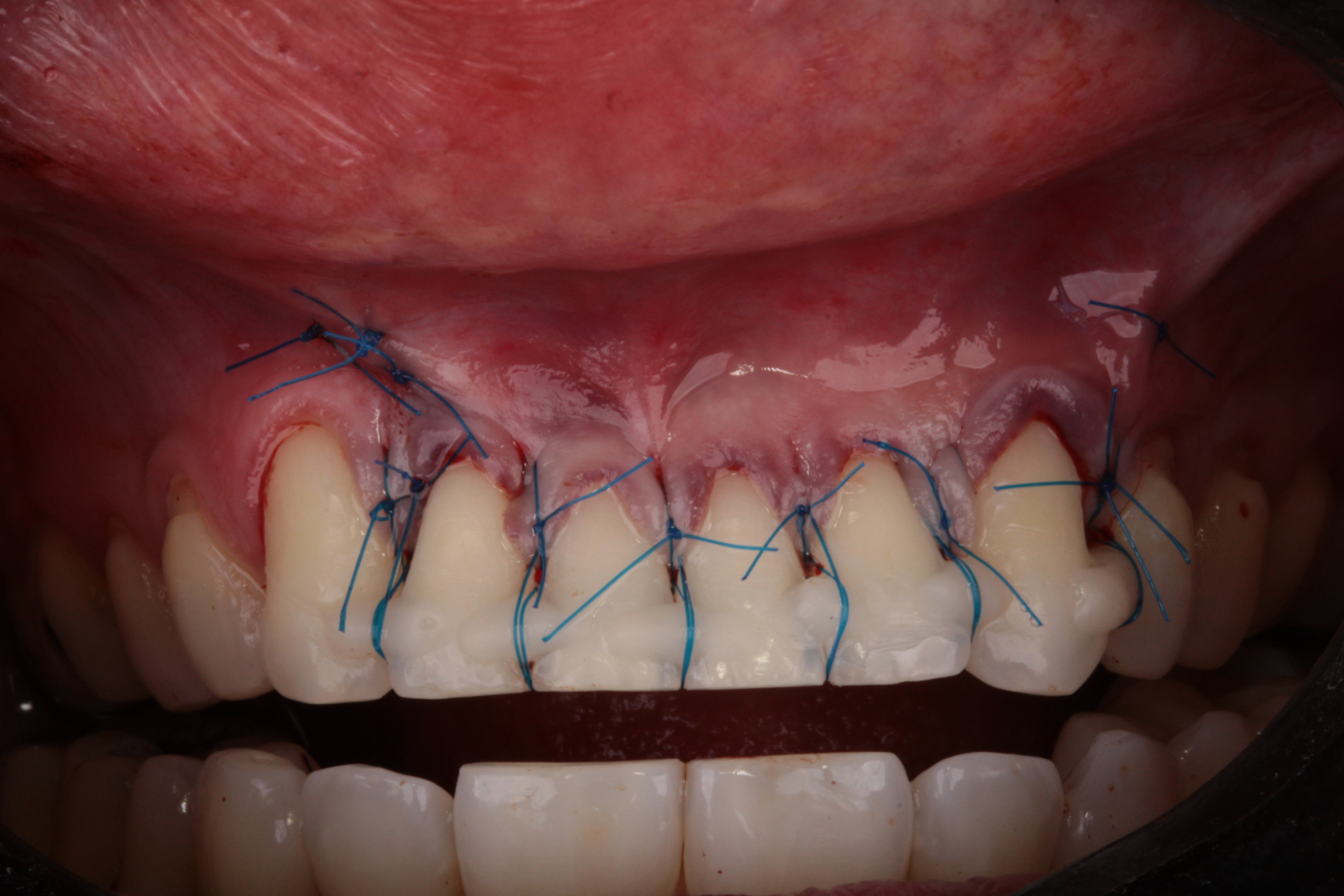 Multiplas Recessões Gengivais - Foto 4