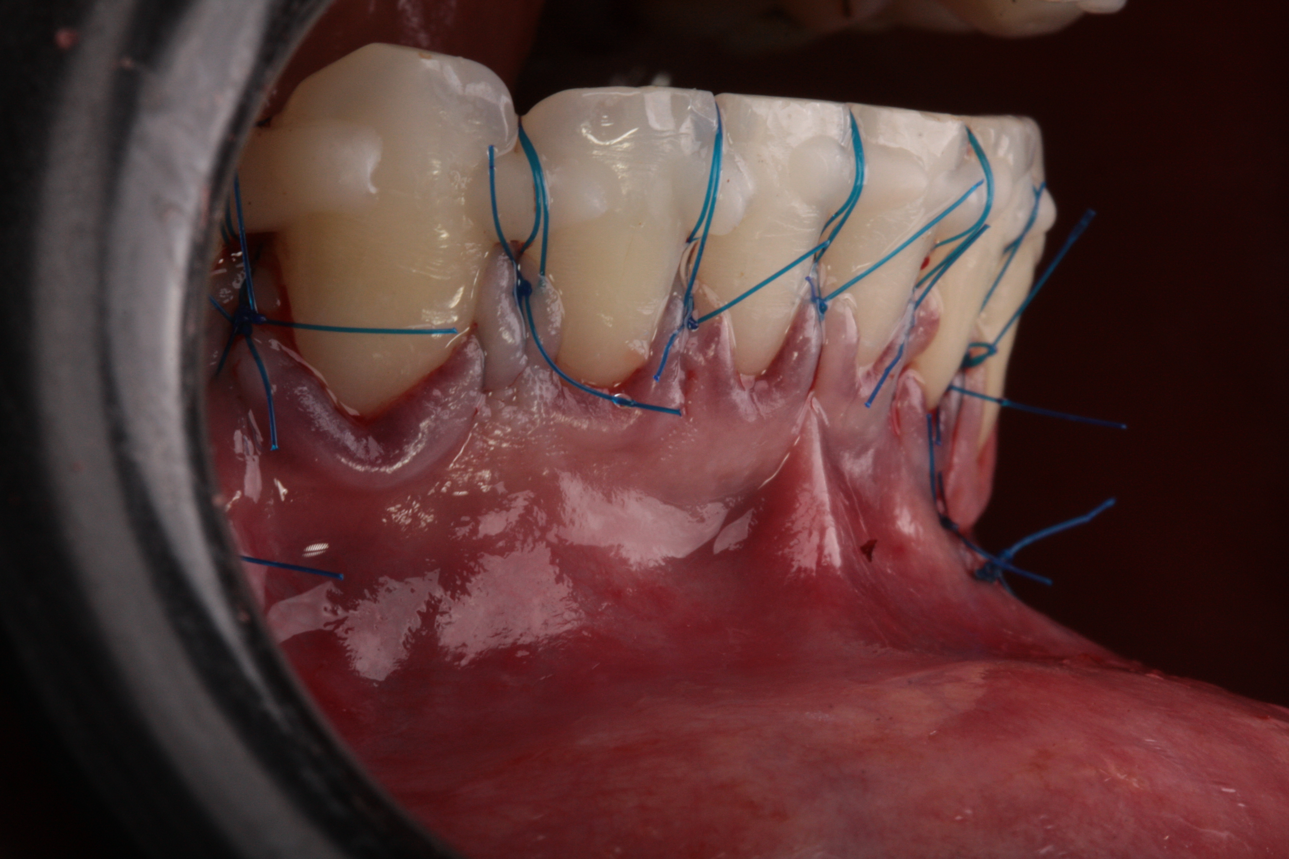Multiplas Recessões Gengivais - Foto 5