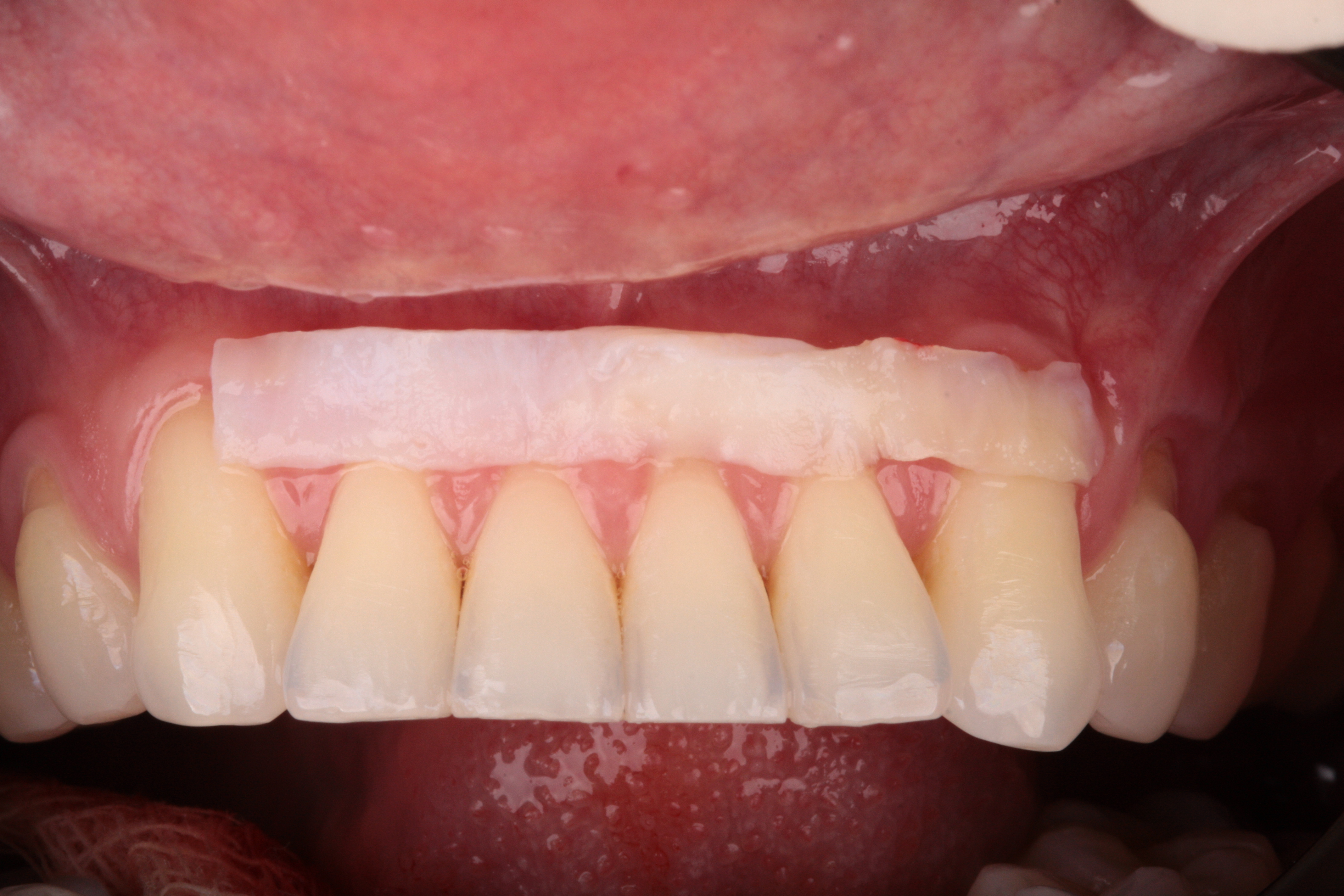 Multiplas Recessões Gengivais - Foto 2