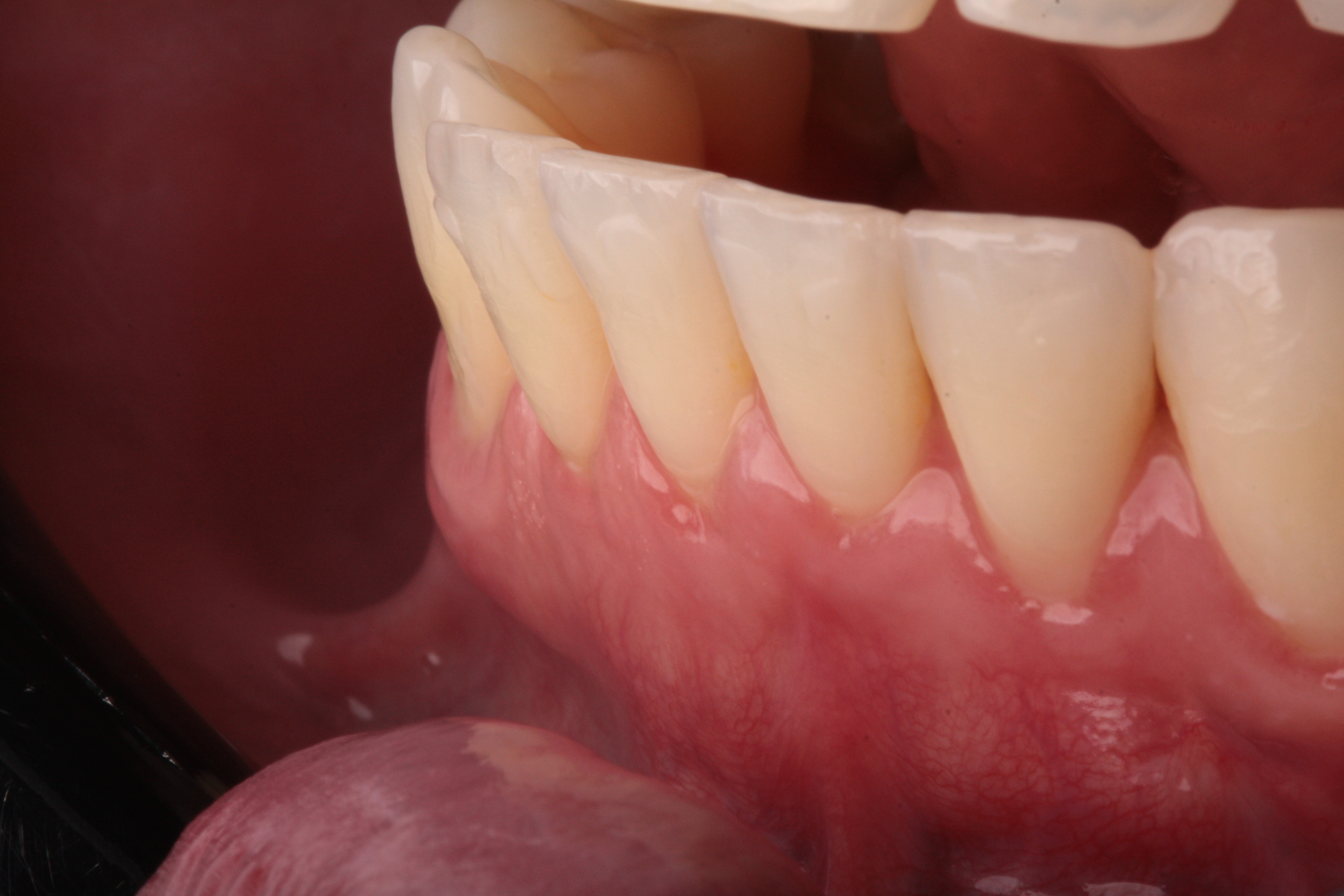 Multiplas Recessões Gengivais - Foto 7