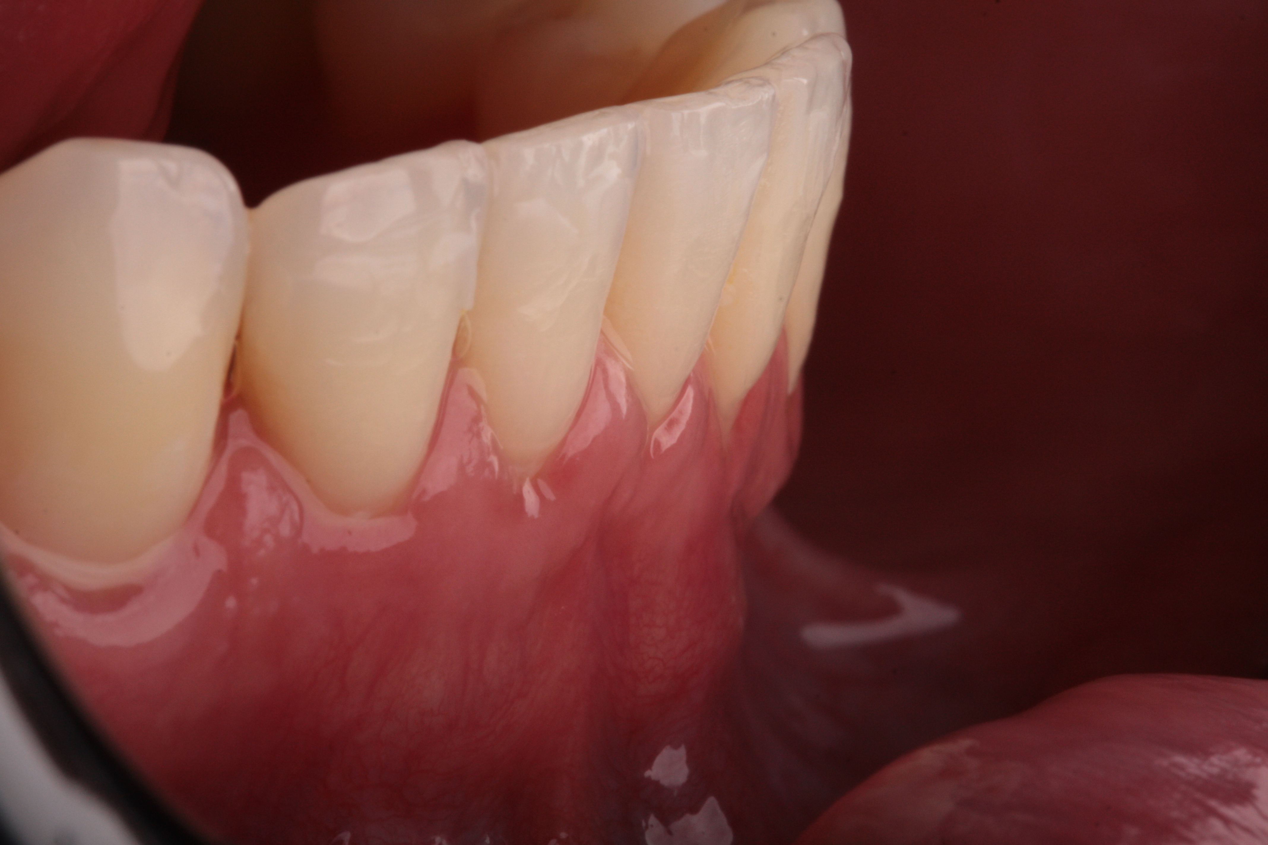 Multiplas Recessões Gengivais - Foto 8