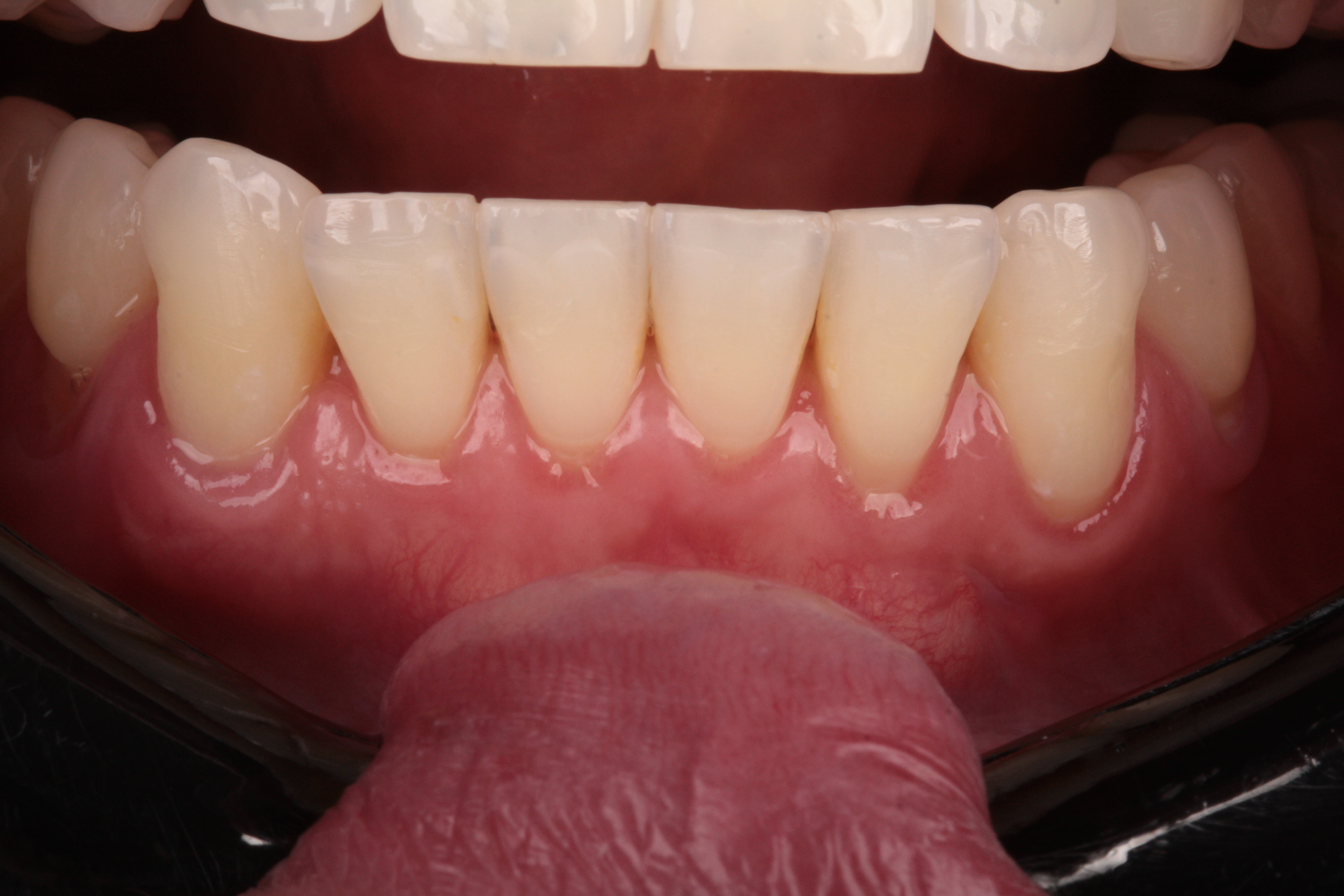 Multiplas Recessões Gengivais - Foto 6