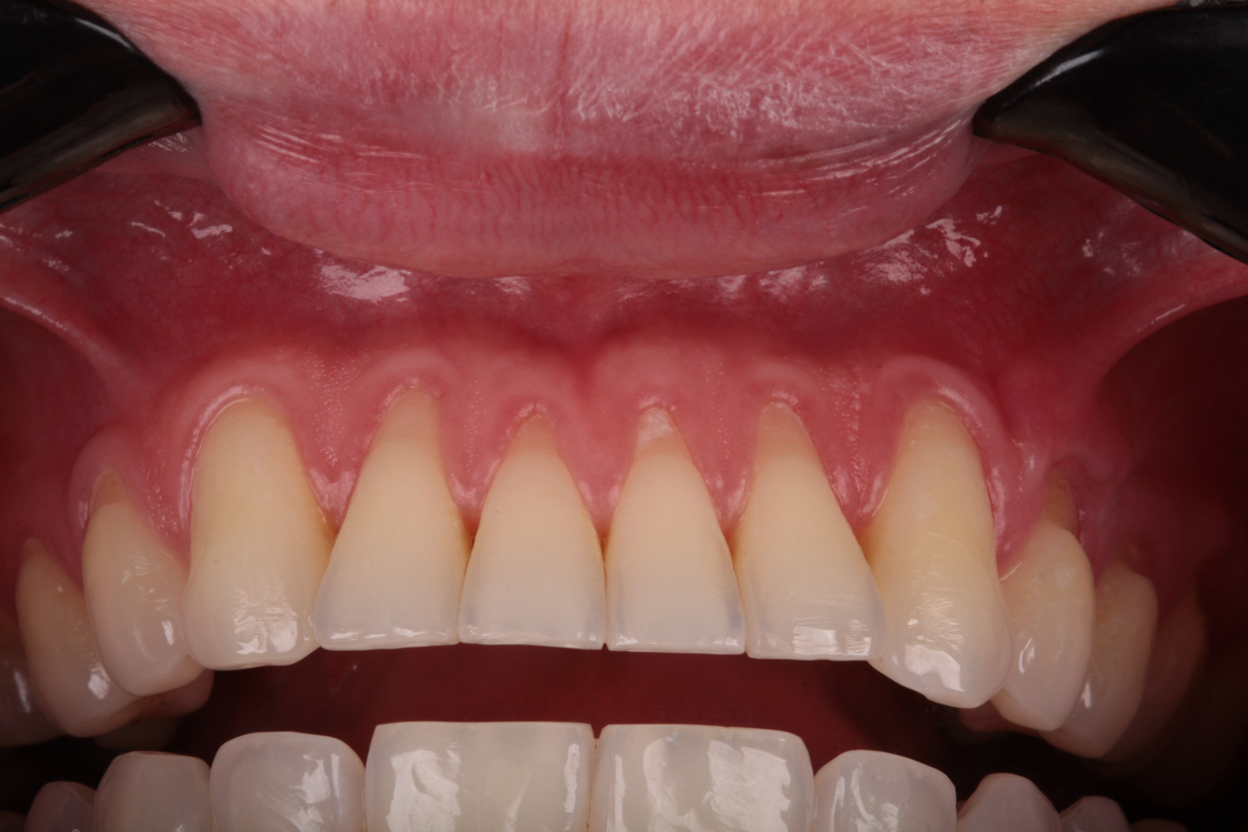 Multiplas Recessões Gengivais - Foto 1