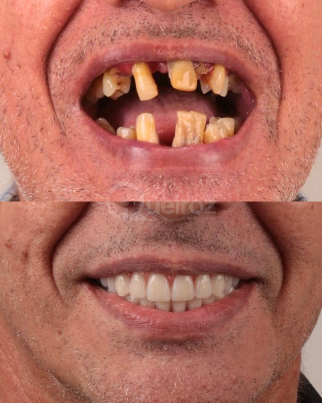 Implantes Dentários