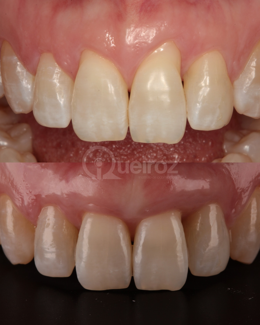 Recobrimento Radicular